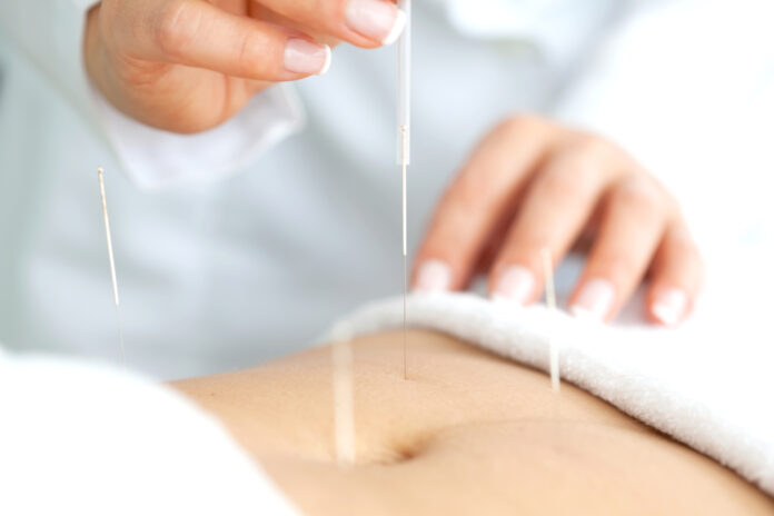 Médico aplicando acupuntura en el abdomen de un paciente