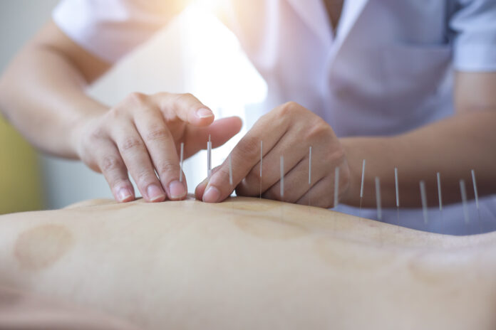 Traditional Chinese Medicine Treatment - Acupuncture