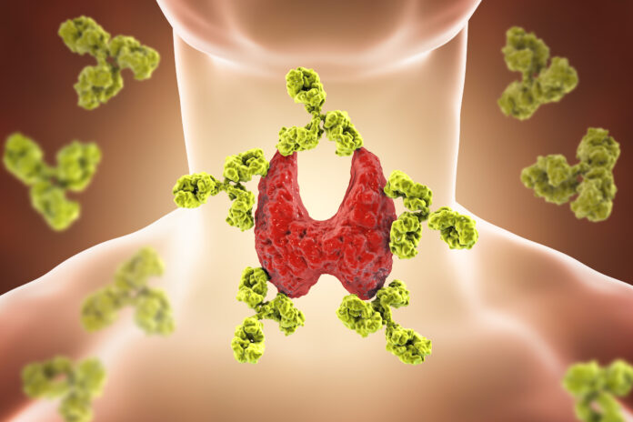 Tiroiditis autoinmune, enfermedad de Hashimoto. Ilustración en 3D que muestra los anticuerpos que atacan la glándula tiroides