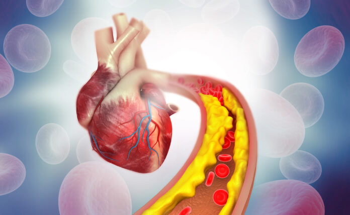 Cholesterin Plaque in Arterie mit menschlichen Herz Anatomie. 3d Illustration