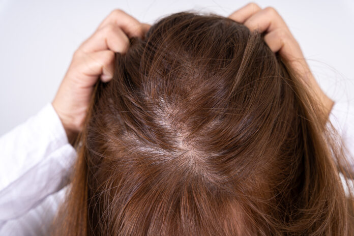 Close up woman head hair loss. Thinning hair on head. Healthcare medical or daily life concept.