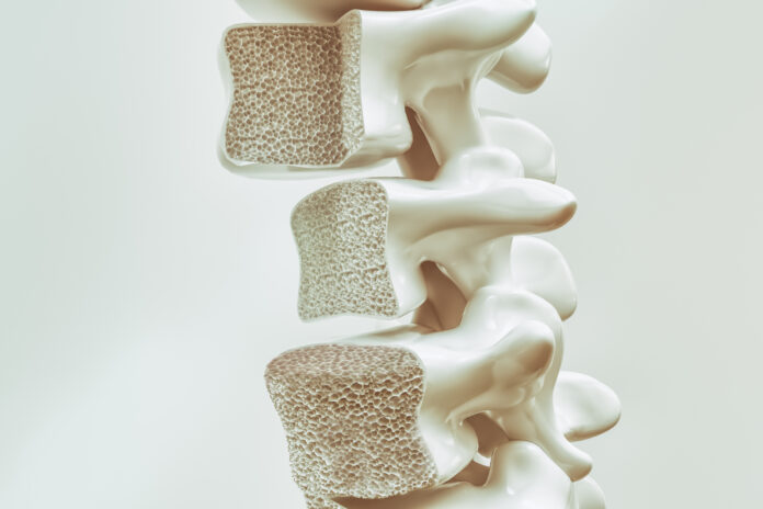Osteoporosis en la columna vertebral -- Representación en 3D