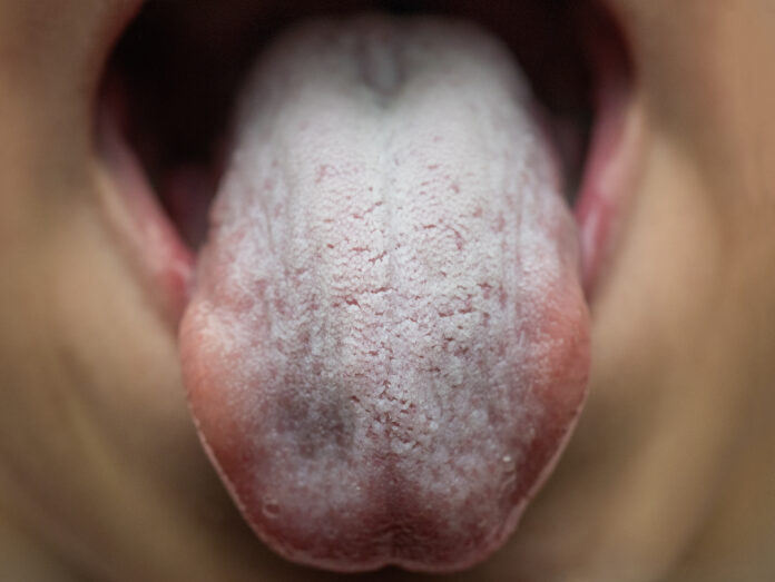 Closeup or macro shot infected by bacteria kid or children toungue disease