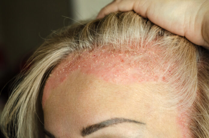 Dermatological skin disease. psoriasis, eczema, dermatitis, allergies. Skin lesions on the head. Red areas on forehead and ears.