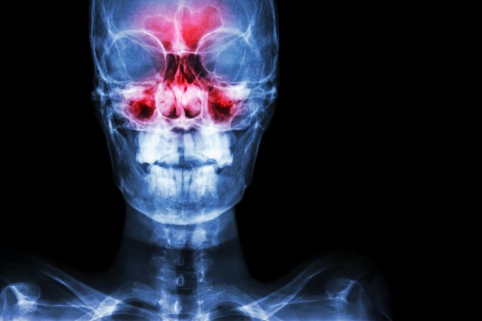 Sinusite. filme de raio-x do crânio AP ( anterior - posterior ) mostra infecção e inflamação no seio frontal, seio etmoidal, seio maxilar e área em branco no lado direito