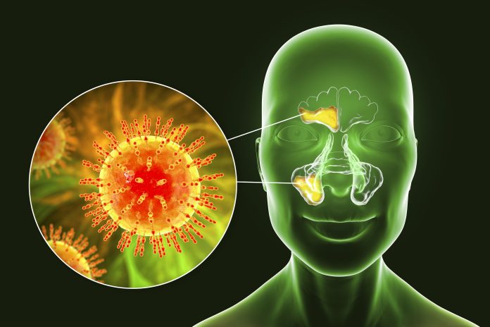 Sinusitis, inflammation of paranasal cavities, computer illustration