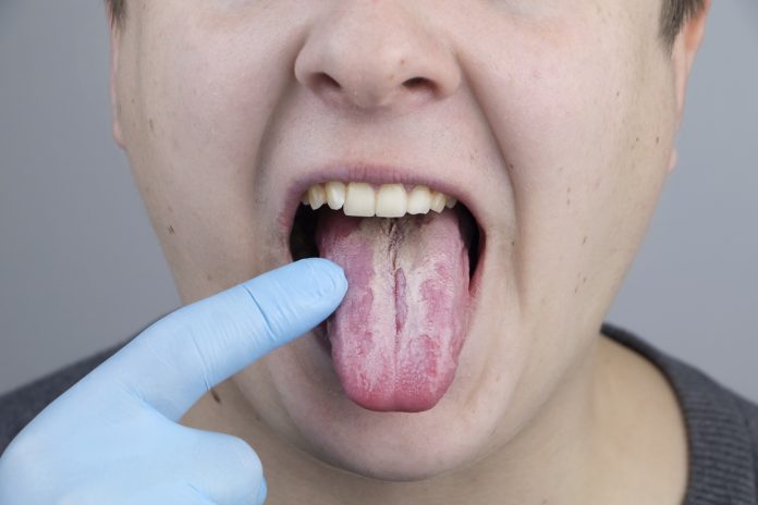 White curd on the tongue. A physician or gastroenterologist examines a man’s tongue. Patient has poor oral hygiene or a symptom of illness